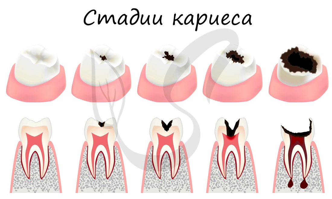 Кариес зубов, стадии кариеса
